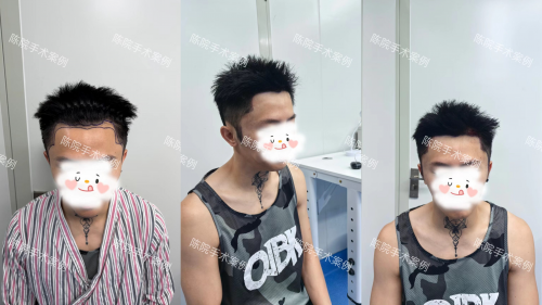 成都双禾植发男士不剃发植发案例,术后即刻到造型期.png