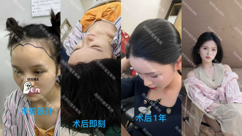 成都双禾植发女士不剃发植发案例,术前设计到术后一年.png
